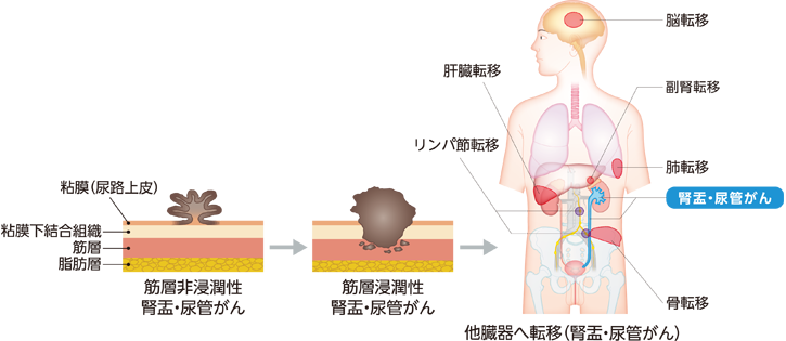 尿路上皮がんの進行の様子