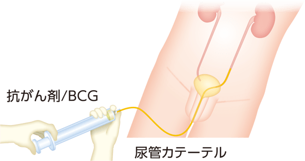 上部尿路注入療法のイメージ