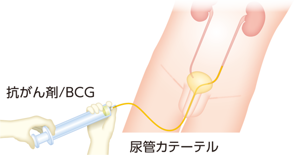 上部尿路注入療法のイメージ