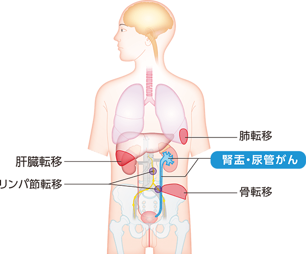 腎盂・尿管がんと転移しやすい場所