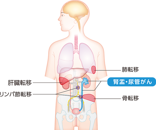 腎盂・尿管がんと転移しやすい場所