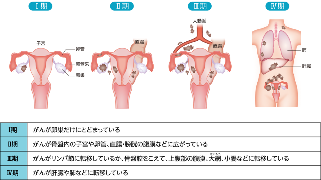 がんの広がりによる分類