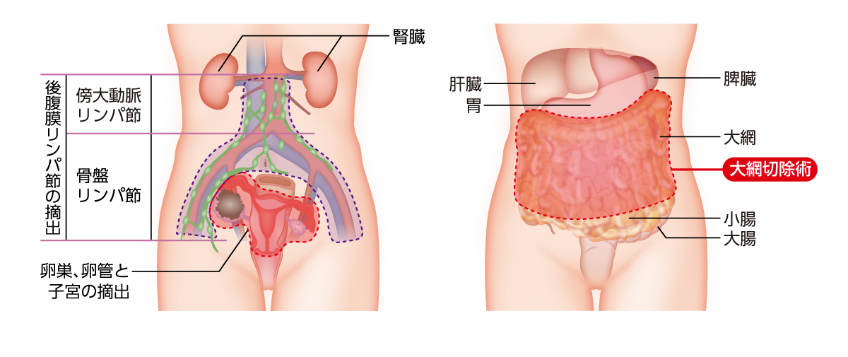 治療 (手術、薬物療法など) | 卵巣がん | MSD oncology がんを生きる