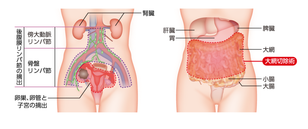 卵巣がんの手術範囲