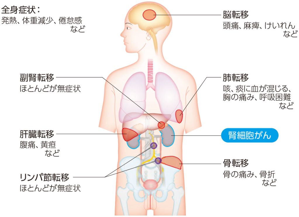 腎細胞がんが再発・転移しやすい場所と主な症状