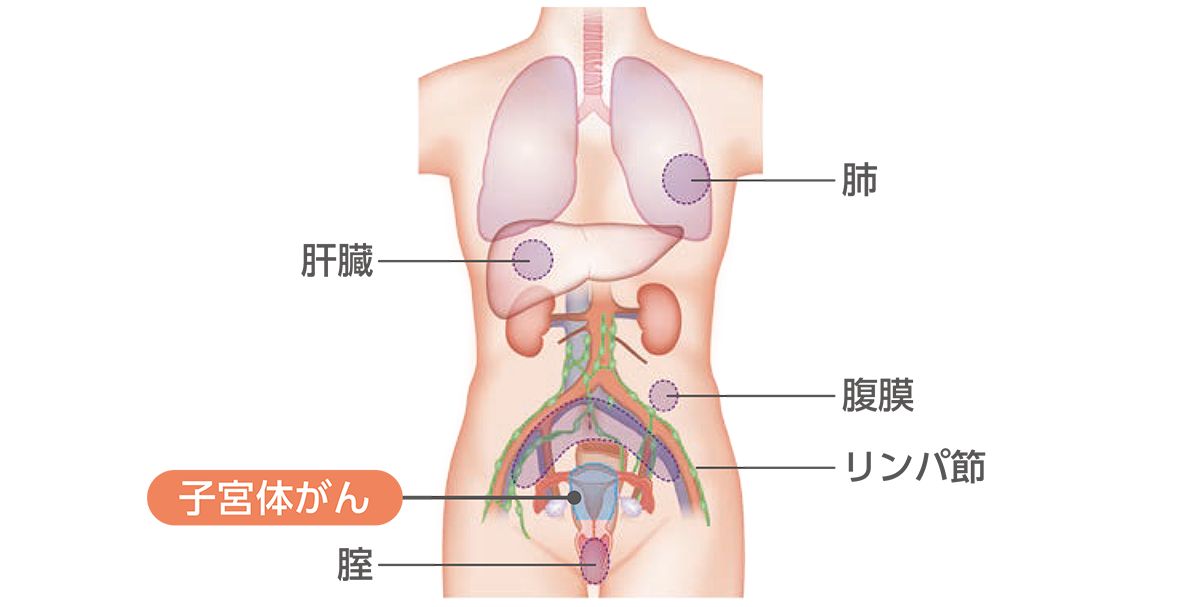子宮体がんで転移・再発が起こりやすい場所（卵巣・卵管以外）