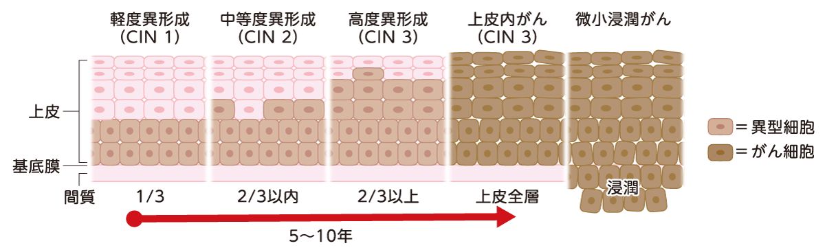 扁平上皮内の前駆病変から発がんまでの進行イメージ