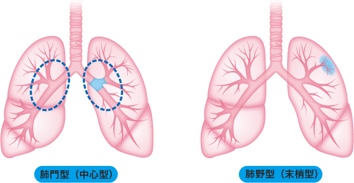 肺門型（中心型）と肺野型（末梢型）