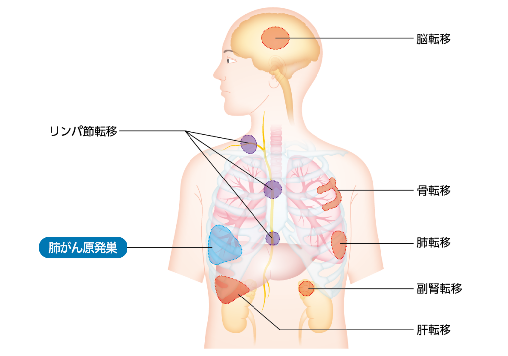 脳転移・リンパ節転移・骨転移・肺転移・副腎転移・肝転移 肺がん原発巣
