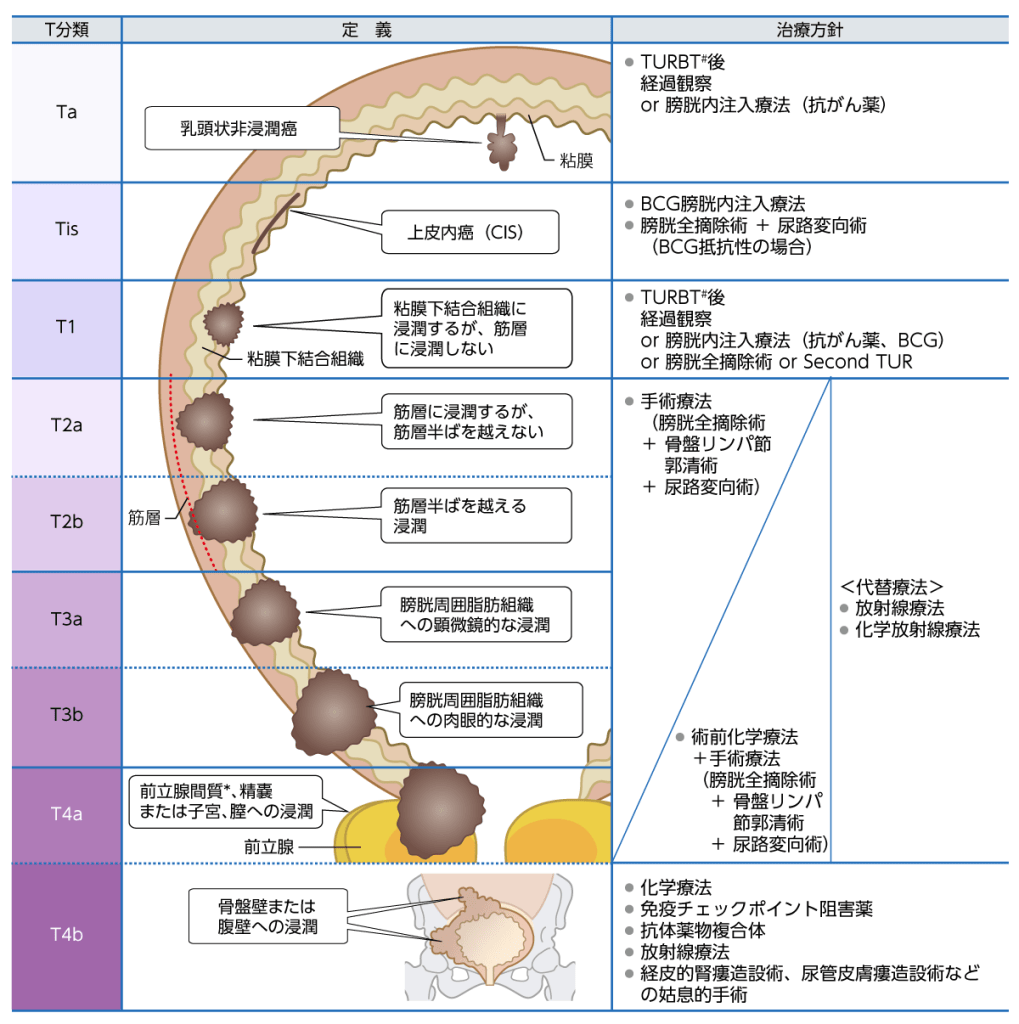 膀胱がんの深達度の定義と基本的な治療