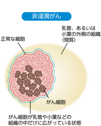 非浸潤がんのイメージ