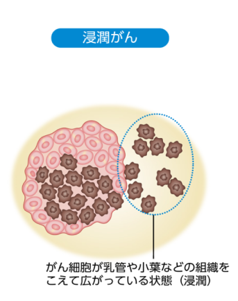 浸潤がんのイメージ