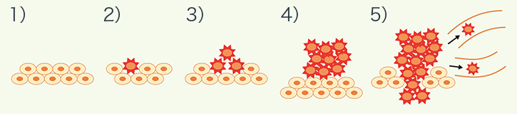 「正常細胞」 ↓ 「異常な細胞」遺伝子の傷 ↓ 「がん化」異常な細胞が増えたり周りに広がる ↓ 「腫瘍形成」がん細胞がかたまりとなり、周りに広がったり、移動しやすくなる ↓ 「転移・浸潤」さらに遠くの組織・臓器に広がる​