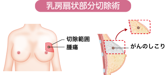 乳房扇状部分切除術イメージ