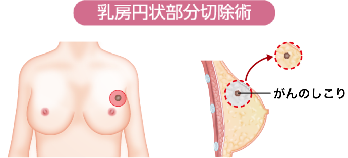乳房円状部分切除術イメージ