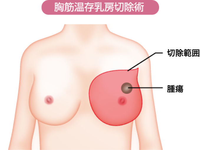 胸筋温存乳房切除術イメージ