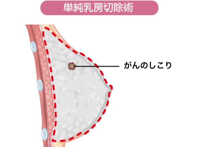 単純乳房切除術イメージ