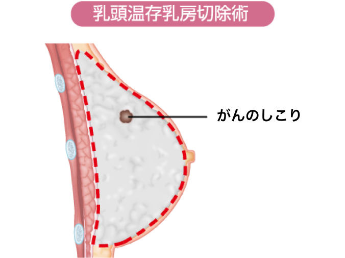 乳頭温存乳房切除術イメージ