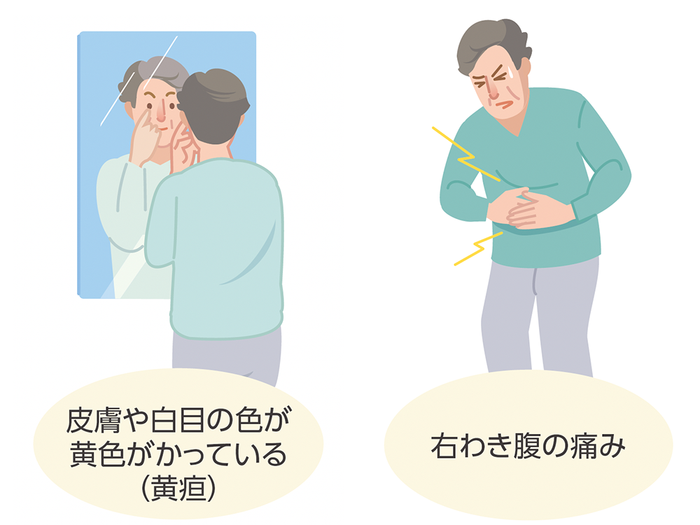胆道がんの症状である黄疸と右わき腹の痛みのイラスト