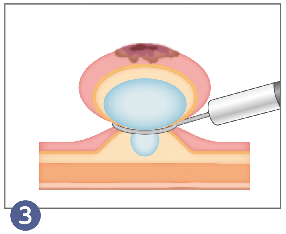 3.内視鏡的粘膜切除術(EMR)