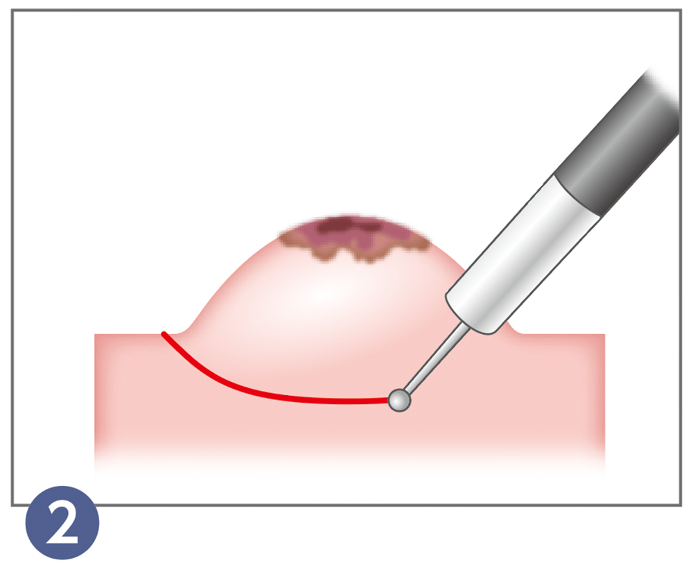 2.内視鏡的粘膜下層剥離術（ESD）