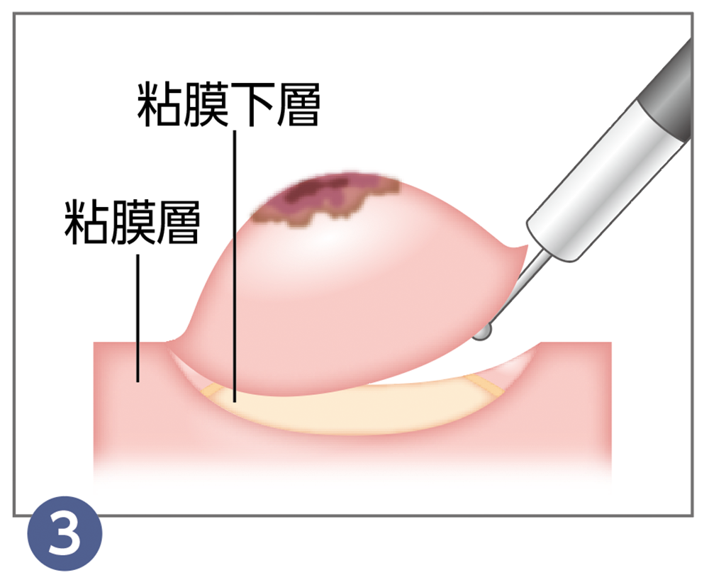 3.内視鏡的粘膜下層剥離術(ESD)