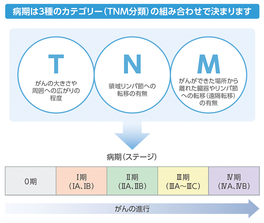 胆道がんの病期分類のイメージ​