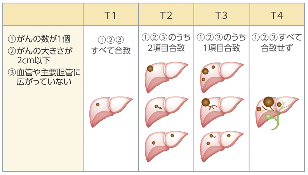 肝内胆管がんの病期分類の表