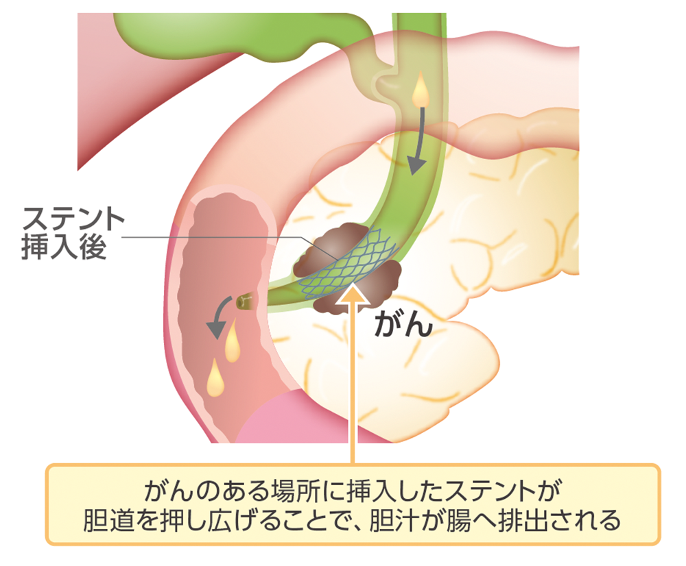 内視鏡を用いるなどしてステントを挿入するイラスト