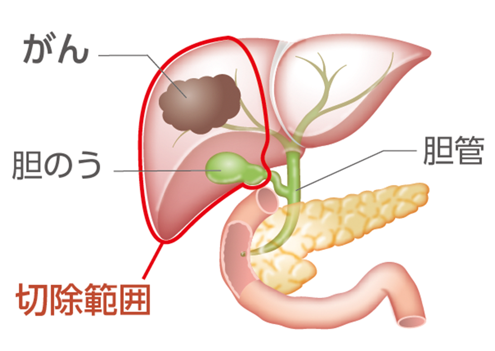 肝内胆管がんの手術例のイラスト