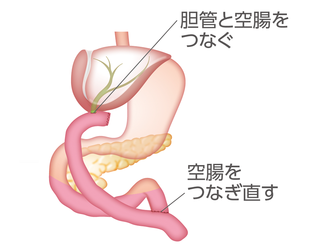 肝門部領域胆管がんの手術例のイラスト(再建後)