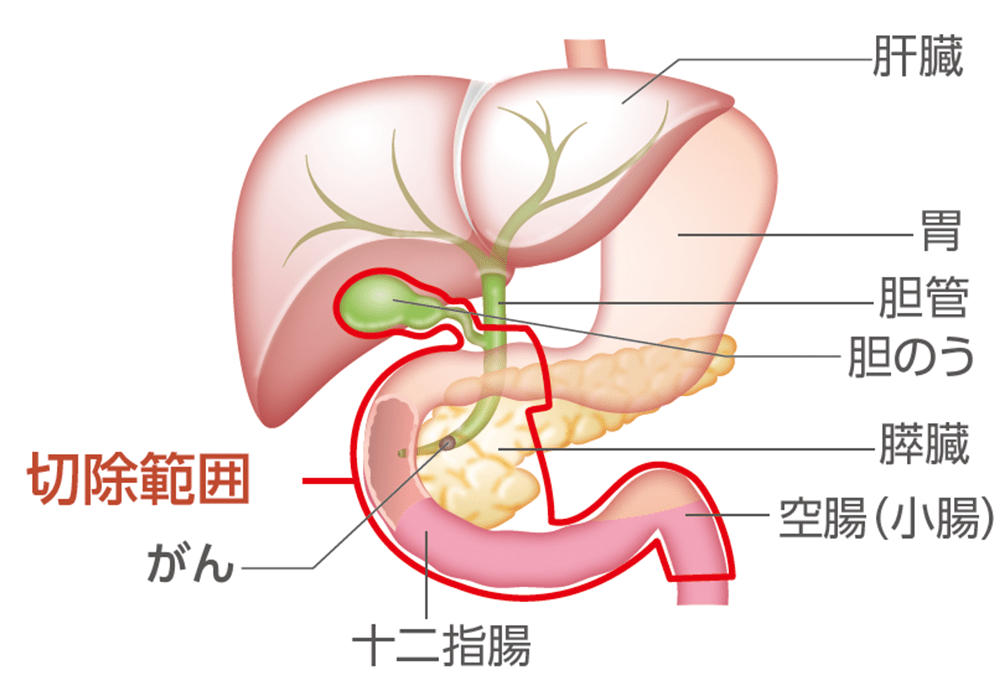 遠位胆管がん、十二指腸乳頭部がんの手術例のイラスト（切除前）