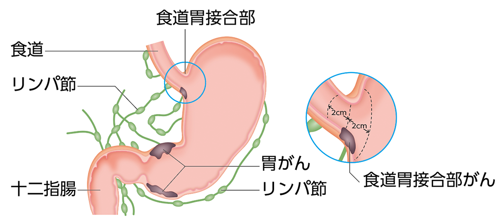 胃がんの発生