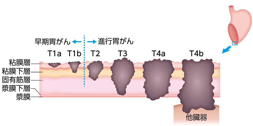 胃がんの深達度