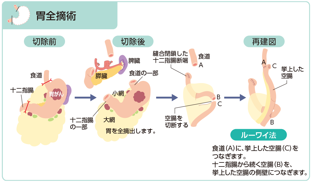 切除術式と消化管再建術(胃全摘術)