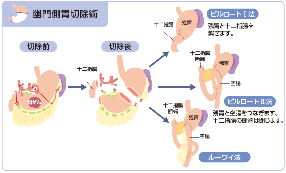 切除術式と消化管再建術(幽門側胃切除術)