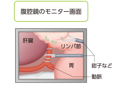 腹腔鏡手術