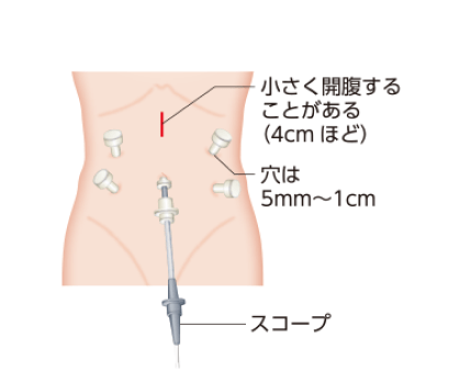 腹腔鏡手術