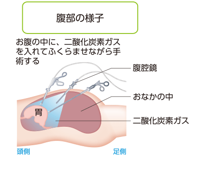 腹腔鏡手術
