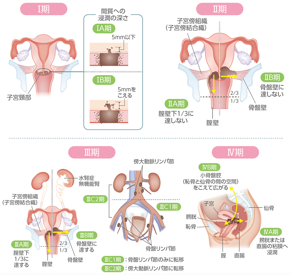 子宮頸がんの進行期ごとの広がり方（イメージ図）1-3）