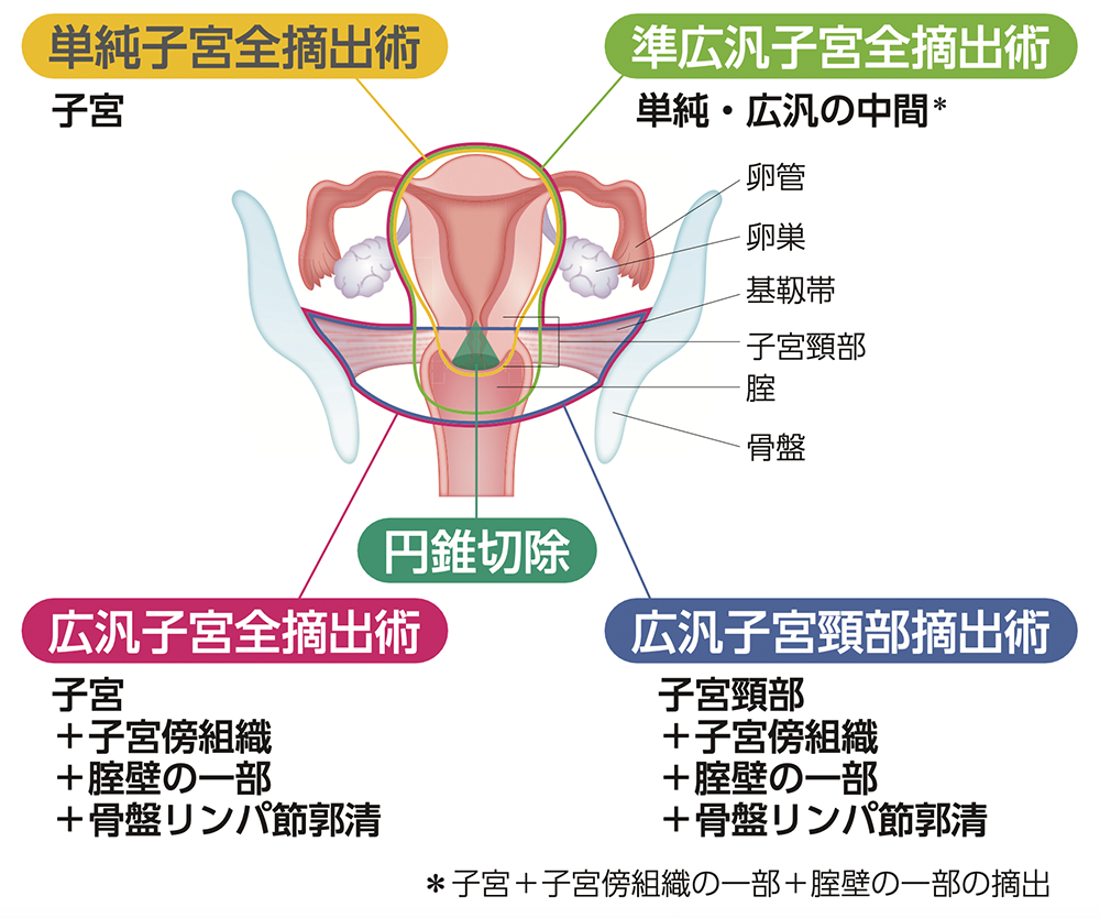 子宮頸がんでは、どんな手術をするのでしょうか？