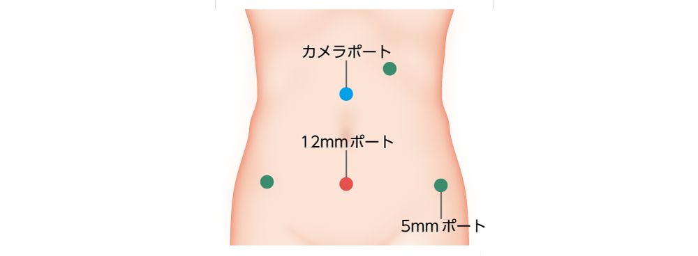 腹腔鏡下手術におけるトロカーの挿入位置例