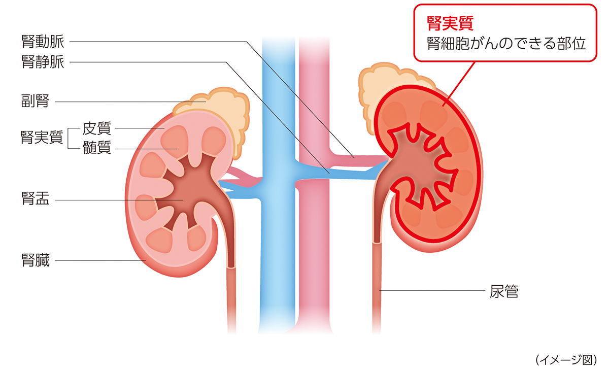 腎臓と腎細胞がん