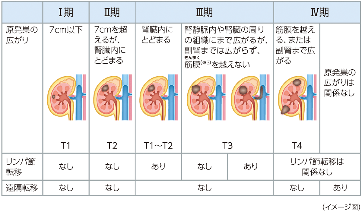 腎細胞がんの病期分類（TNM分類）