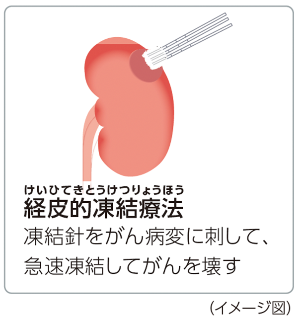 経皮的凍結療法