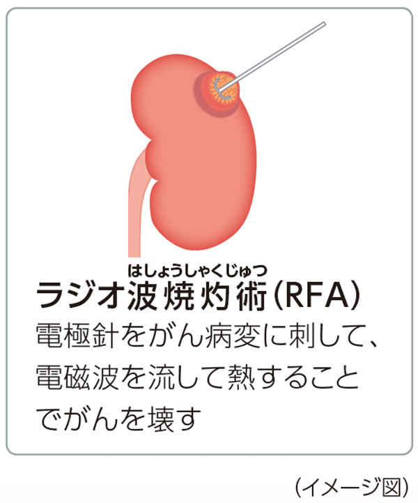 ラジオ波焼灼術