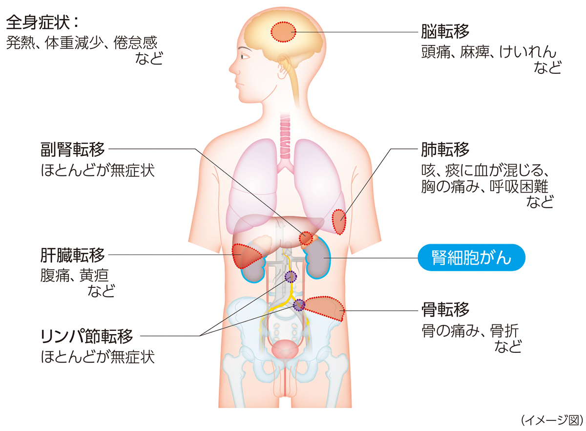 腎細胞がんが再発・転移しやすい場所と主な症状
