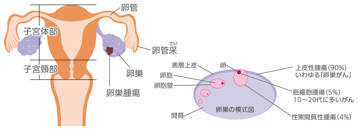 卵巣がんの発生部位