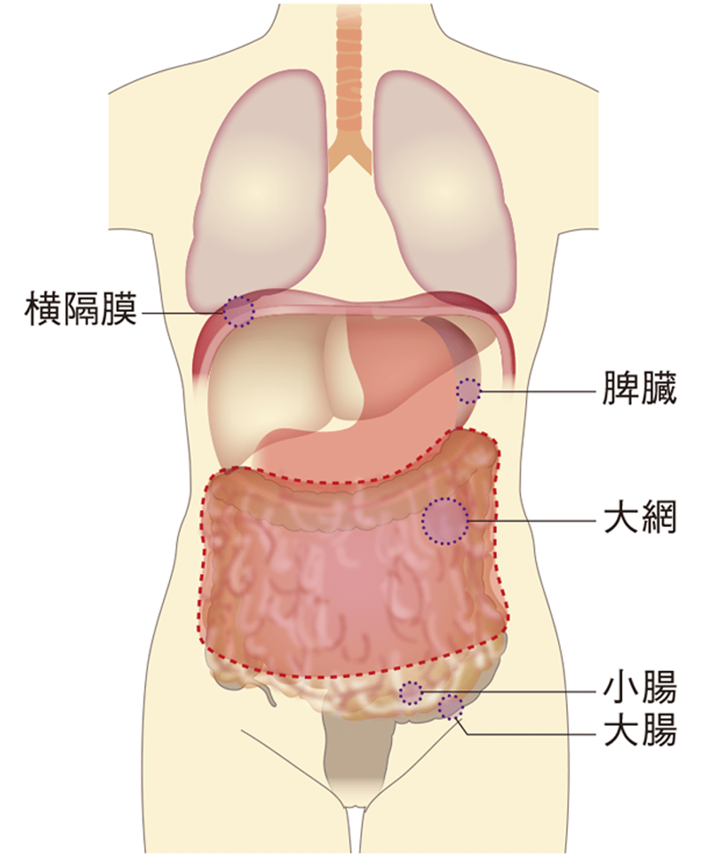卵巣がんの転移・再発が起こりやすい場所 をまとめたイラスト