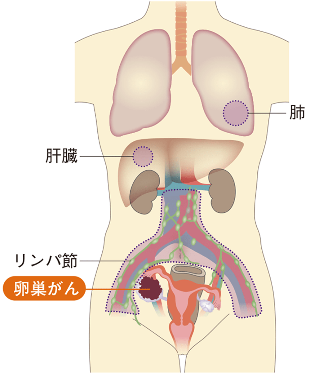 卵巣がんの転移・再発が起こりやすい場所 をまとめたイラスト